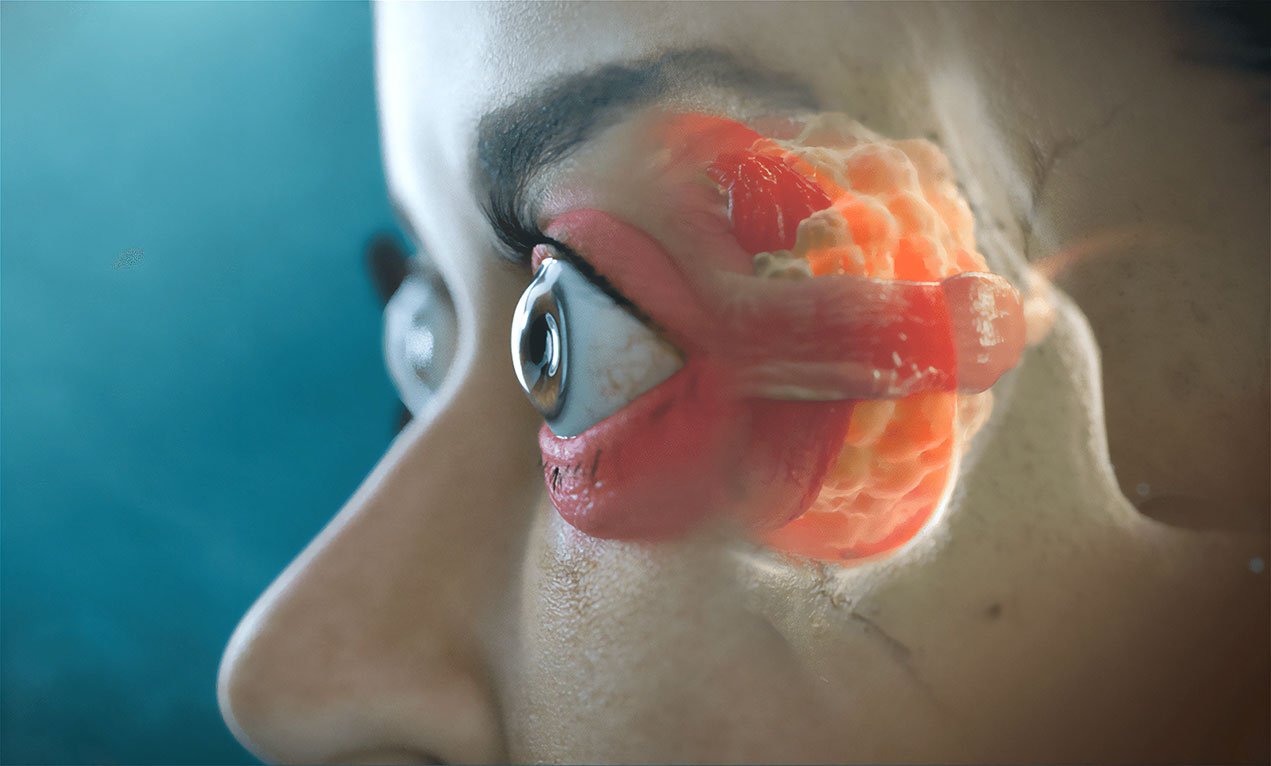 Medizinische Illustration eines Auges mit endokriner Orbitopathie.