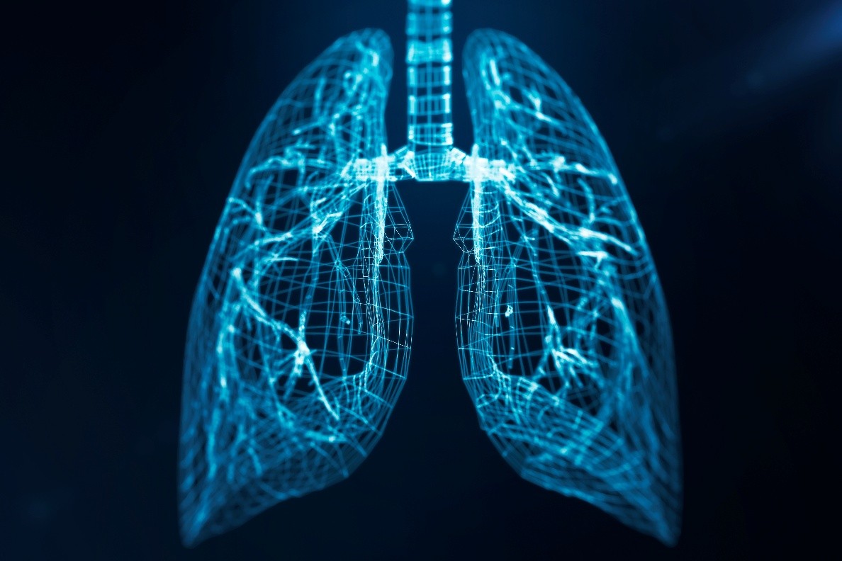 Schematische Darstellung der Lunge mit Bronchialsystem zur Illustration des kleinzelligen Lungenkarzinoms (SCLC).